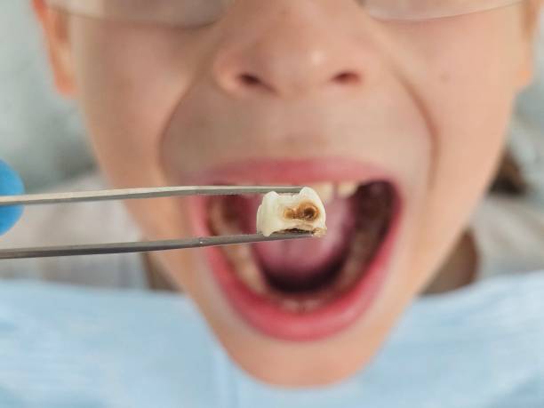 Best Emergency Wisdom Teeth Removal in Stuart, FL